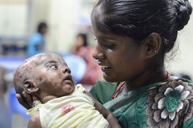 В Индии трехмесячный малыш страдает от самовоспламенения