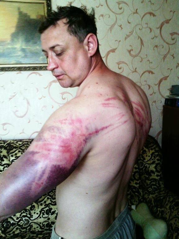 Бывший пленный "ДНР" показал, как издевались террористы. Фотофакт