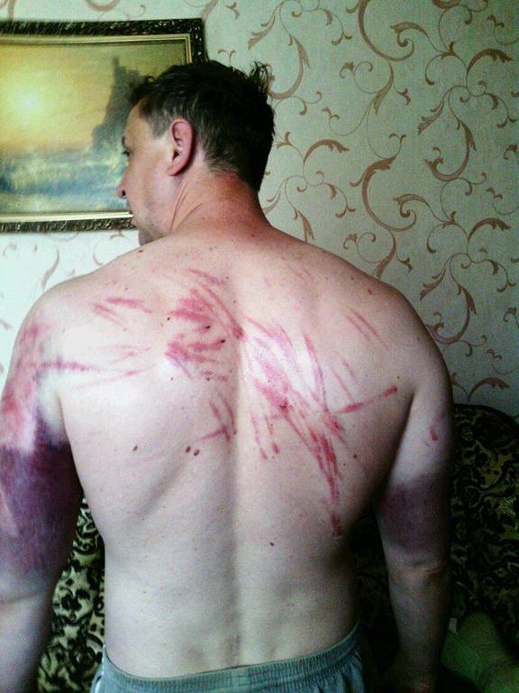 Бывший пленный "ДНР" показал, как издевались террористы. Фотофакт