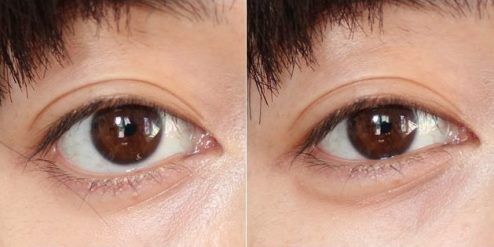 Мешки под глазами — новая модная тенденция в Корее