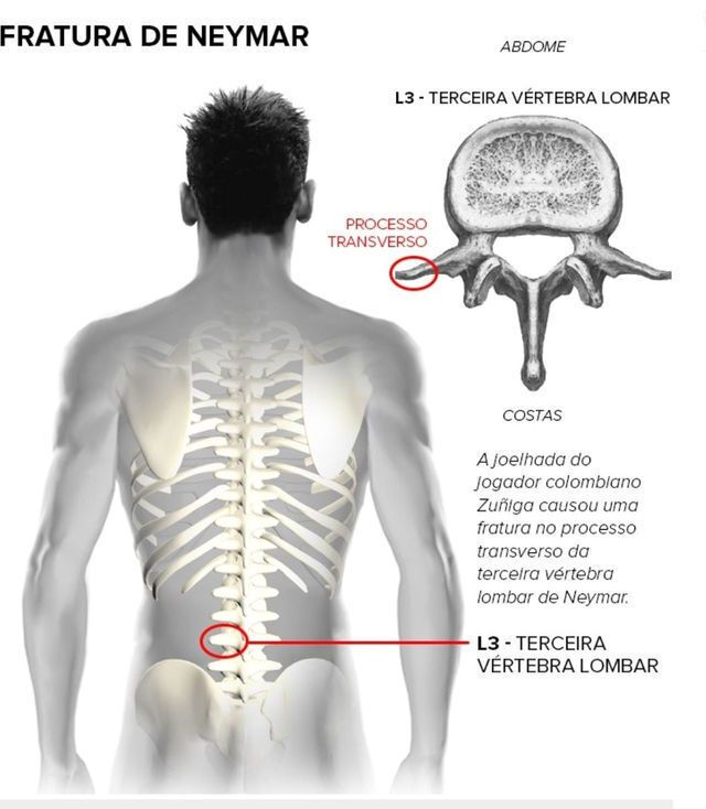 ЧМ-2014. Опубликован рентгеновский снимок переломанного позвонка Неймара