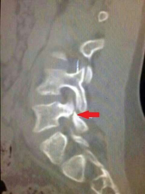 ЧМ-2014. Опубликован рентгеновский снимок переломанного позвонка Неймара