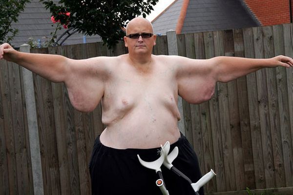 Самый толстый британец похудел на 305 кг ради любимой женщины
