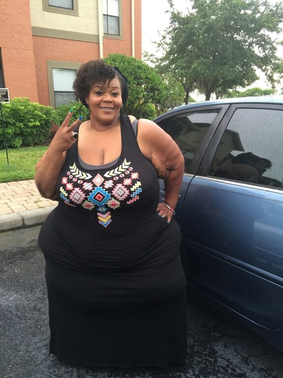 Найтовстіша жінка у світі скинула 230 кг: фотофакт