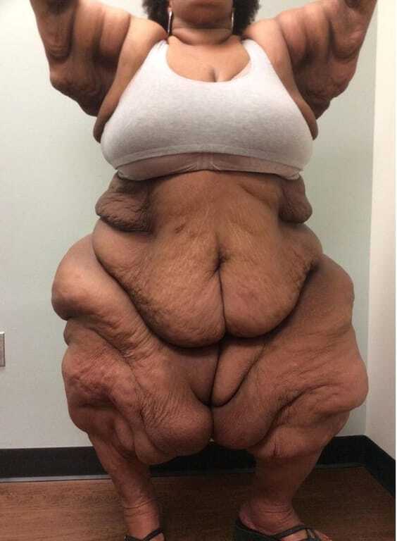 Самая толстая женщина в мире скинула 230 кг: фотофакт