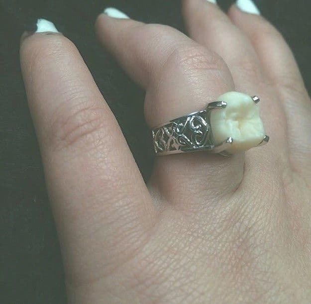 Парень подарил невесте обручальное кольцо со своим зубом