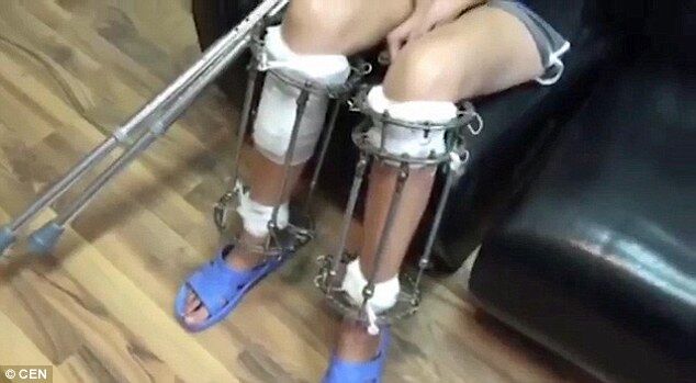 Девушка пошла на операцию по удлинению ног, чтобы стать моделью