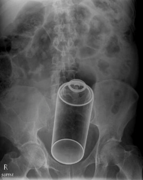 Рентген-снимки инородных предметов, на которые ''случайно'' садятся люди