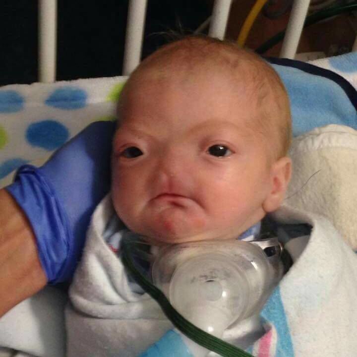 В США родился ребенок без носа