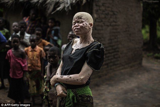 $75 тисяч за тіло: в Африці чаклуни оголосили полювання на альбіносів