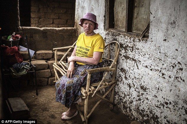 $75 тысяч за тело: в Африке колдуны объявили охоту на альбиносов