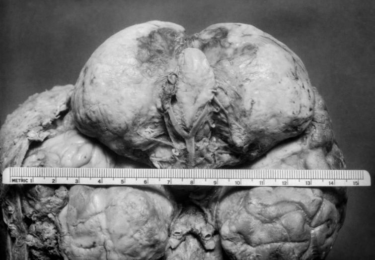 Обнаружены фото пациентов, которые перенесли одни из первых операций на мозге