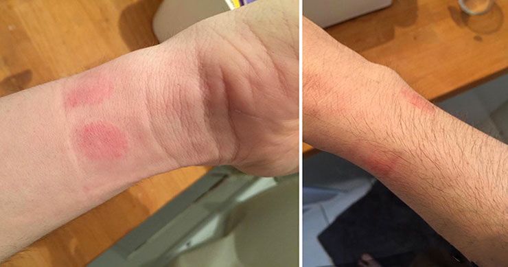 У пользователей Apple Watch начались проблемы с кожей. Фотофакт