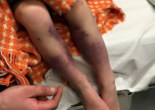 Четырехлетняя девочка заболела ветрянкой и чуть не потеряла ноги