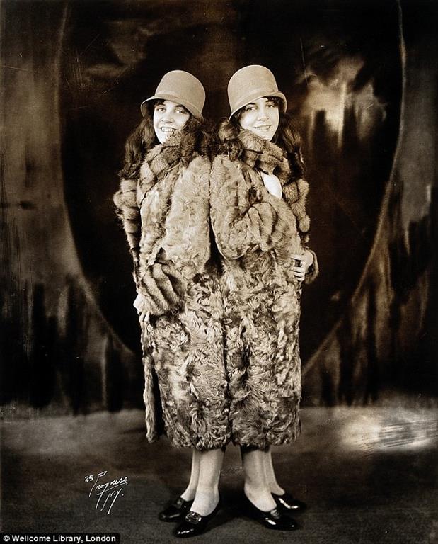 Сестри Хілтон: історія сіамських близнюків, які стали світськими левицями