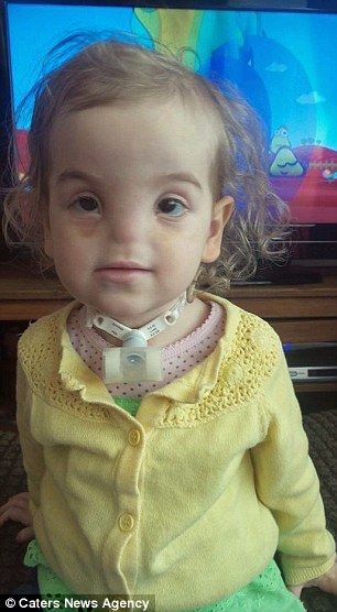 2-летней девочке, родившейся без носа, врачи вырастят недостающий орган