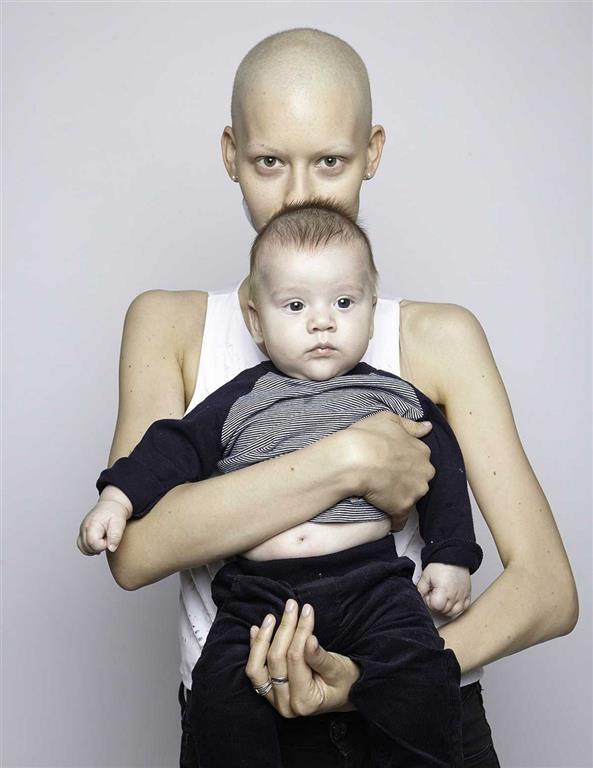 Потрясающие снимки модели, которая потеряла челюсть из-за рака