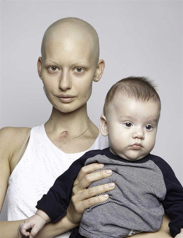 Потрясающие снимки модели, которая потеряла челюсть из-за рака