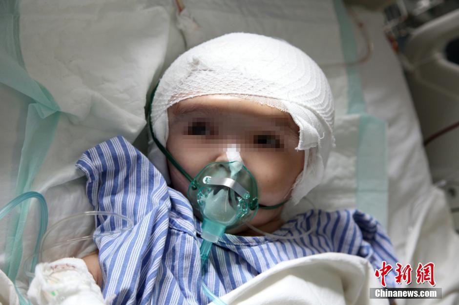 В Китае врачи впервые в мире уменьшили голову ребенка