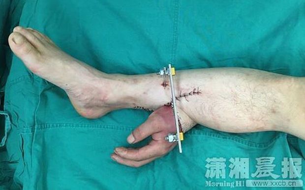 Китайські хірурги пришили руку пацієнта до його ноги: фотофакт