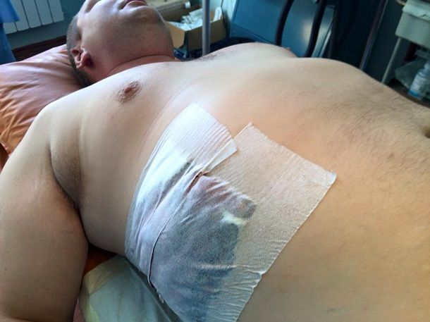 Раненого в АТО Булатова отправили в Киев: экс-министр поделился жуткими фото с операции