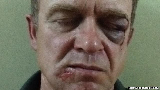 Зверски избили активиста, чья жена помогла СМИ выявить скандальное имущество мэра Ирпеня: фотофакт