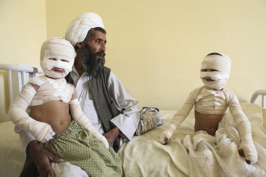 Покалічені війною: в мережі з'явилися шокуючі знімки дітей Афганістану