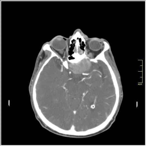 Украинские врачи успешно удалили гигантскую опухоль головного мозга: опубликованы фото