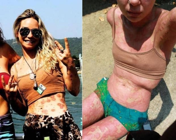 24-летняя британка с тяжелой формой псориаза показала свое тело в бикини