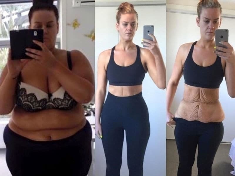 Мережу вразили фотографії дівчини, яка схудла за рік вдвічі: фотофакт