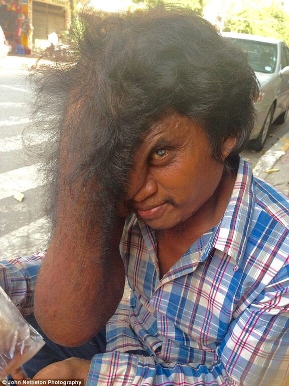 В Камбодже "человек-индюк" нашел "ангелов хранителей" из Австралии: опубликованы фото 18+