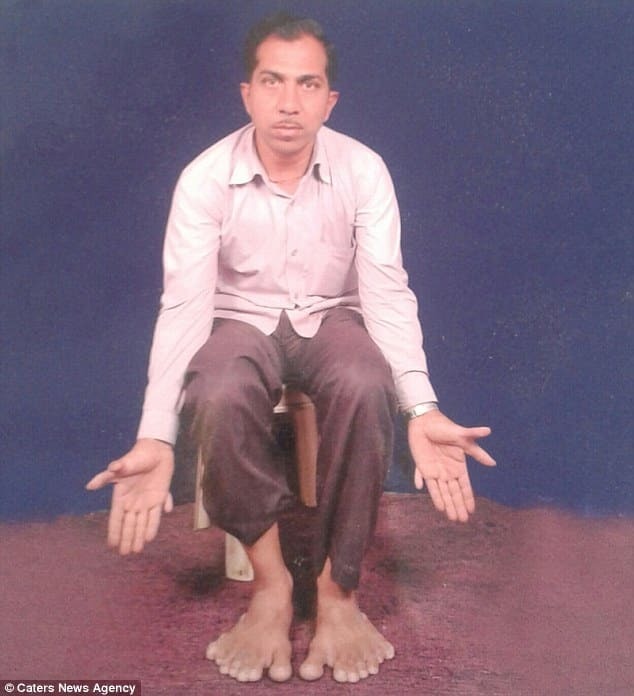 Чудеса природы: в Индии живет мужчина-рекордсмен с 28-мя пальцами