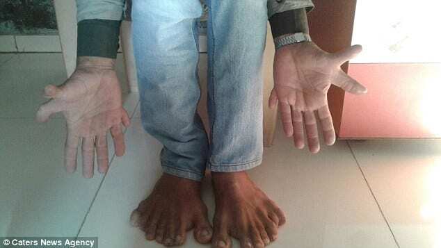 Чудеса природи: в Індії живе чоловік-рекордсмен з 28-ма пальцями