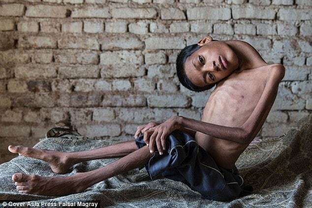 "Так страдал, что лучше бы умер": врачи спасли индийского мальчика с "резиновой" шеей
