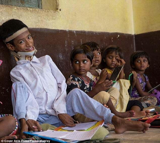 "Так страдал, что лучше бы умер": врачи спасли индийского мальчика с "резиновой" шеей