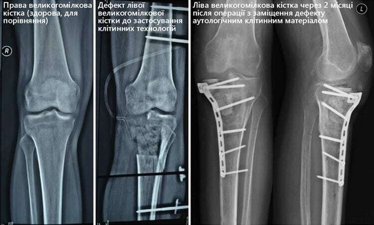 Українські лікарі-біотехнологи відновили колінний суглоб бійцю Нацгвардії