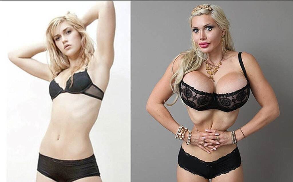 Джоли на зависть: шведка раздула губы до рекордных размеров