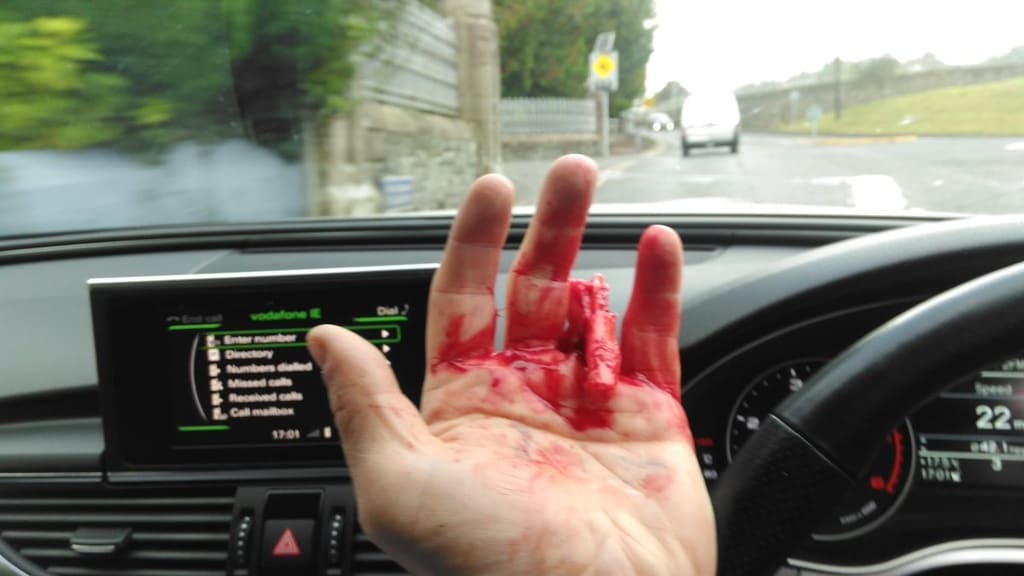 Ирландскому футболисту оторвало палец во время неудачного прыжка: фотографии не для слабонервных