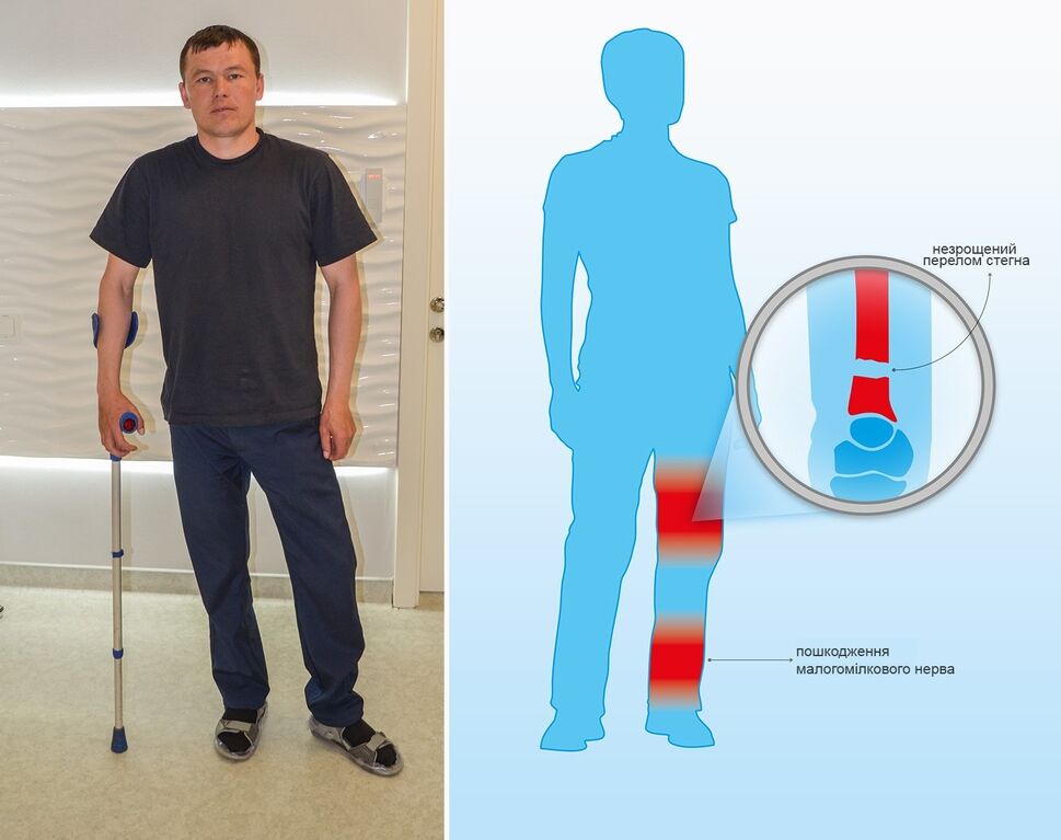 Загрожує довічна інвалідність: боєць АТО потребує термінової допомоги