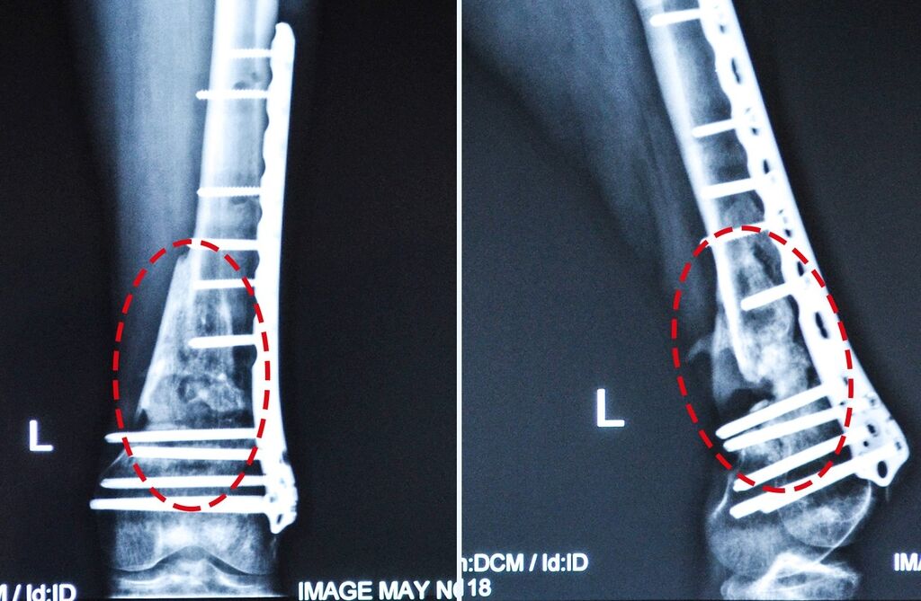 Загрожує довічна інвалідність: боєць АТО потребує термінової допомоги