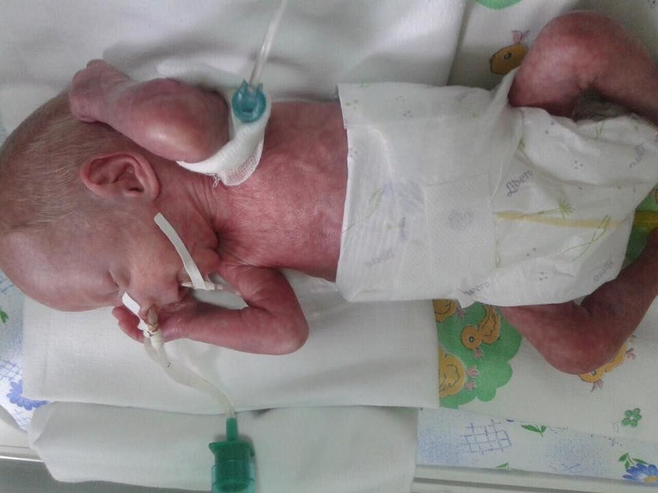 Народився з вагою 860 грамів: хлопчик зі Львова потребує термінової допомоги