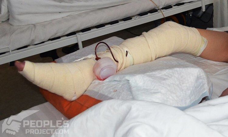 Лікарі з України "виростили" 12 сантиметрів кістки бійцю АТО