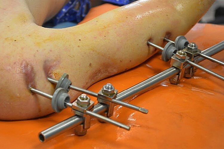 Прорив у медицині: лікарі з України відновили кістки бійця АТО