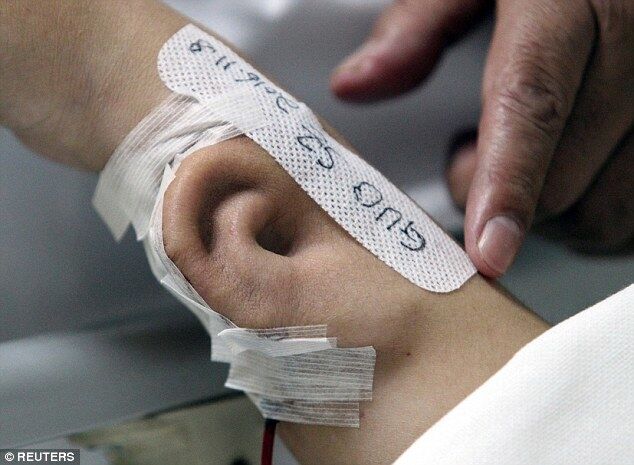 По стопам Франкенштейна: в Китае медики вырастили ухо на руке у пациента. Фотофакт