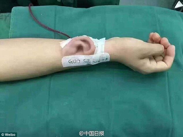 По стопам Франкенштейна: в Китае медики вырастили ухо на руке у пациента. Фотофакт