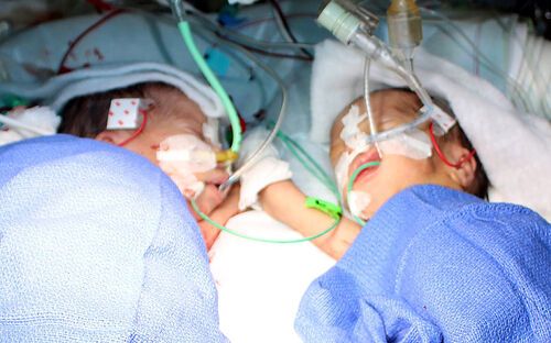 В Швейцарии успешно разделили сиамских близнецов-девочек: фото