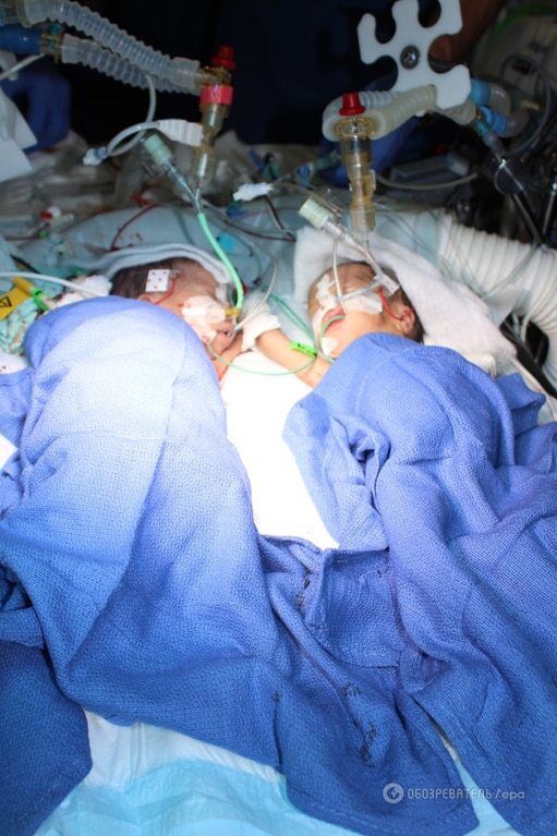 В Швейцарии разделили самых маленьких сиамских близнецов: опубликованы фото