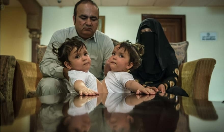 Одно тело – две души: в Саудовской Аравии удачно разделили сиамских близнецов. Невероятные фото