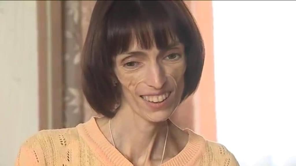 Смогла победить анорексию: история украинки, которая весила 24 кг