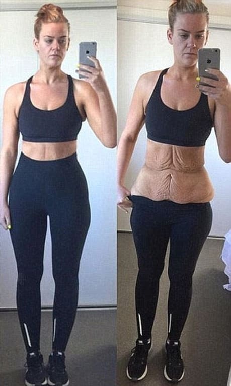 Похудевшая на 92 кг девушка показала фигуру после торсопластики: поразительные фото